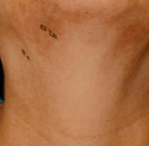 Before/After Image